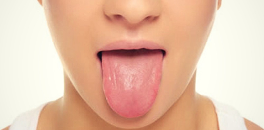 How Tongue Color Can Reveal Health Problems